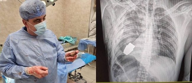 Медики оперувала з гранатою всередині