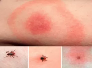 На Сумщині місцеві жителі потерпають від кліщів: кількість хворих на кліщовий бореліоз збільшилася в тричі у порівнянні з минулим роком